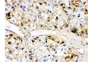 Anti- AHSG Picoband antibody, IHC(P) IHC(P): Human Liver Cancer Tissue (Fetuin A Antikörper  (N-Term))