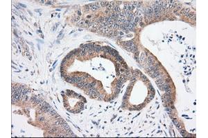 Immunohistochemical staining of paraffin-embedded Human thyroid tissue using anti-USP5 mouse monoclonal antibody. (USP5 Antikörper)