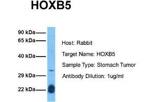 Host: Rabbit Target Name: HOXB5 Sample Tissue: Human Stomach Tumor Antibody Dilution: 1.