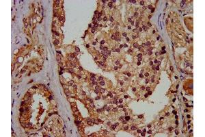IHC image of ABIN7152156 diluted at 1:400 and staining in paraffin-embedded human prostate cancer performed on a Leica BondTM system. (EIF3G Antikörper  (AA 2-320))