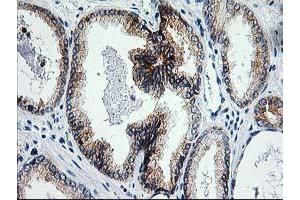 Immunohistochemical staining of paraffin-embedded Carcinoma of Human prostate tissue using anti-ERCC4 mouse monoclonal antibody. (ERCC4 Antikörper)