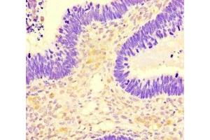 Immunohistochemistry of paraffin-embedded human ovarian cancer using ABIN7169732 at dilution of 1:100