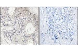 Immunohistochemistry analysis of paraffin-embedded human breast carcinoma tissue, using Cytochrome P450 1A2 Antibody.