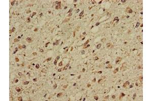 Immunohistochemistry of paraffin-embedded human glioma using ABIN7146829 at dilution of 1:100 (CPT1C Antikörper  (AA 699-803))