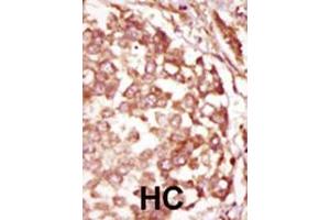 Formalin-fixed and paraffin-embedded human cancer tissue reacted with the primary antibody, which was peroxidase-conjugated to the secondary antibody, followed by DAB staining. (BUB1B Antikörper  (N-Term))
