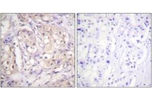 Immunohistochemistry analysis of paraffin-embedded human breast carcinoma, using B-RAF (Phospho-Thr599) Antibody. (SNRPE Antikörper  (pThr599))