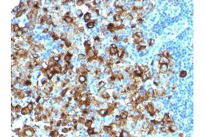 Formalin-fixed, paraffin-embedded human Melanoma stained with gp100 Rabbit Recombinant Monoclonal Antibody (PMEL/1825R). (Rekombinanter Melanoma gp100 Antikörper)