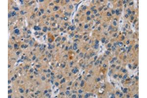 The image is immunohistochemistry of paraffin-embedded Human liver cancer tissue using ABIN7130969(SAR1B Antibody) at dilution 1/20. (SAR1B Antikörper)