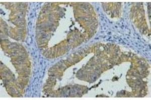 Immunohistochemistry of paraffin-embedded Human colon cancer tissue using CK-8 Monoclonal Antibody at dilution of 1:200. (KRT8 Antikörper)