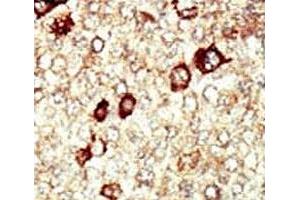 IHC analysis of FFPE human hepatocarcinoma tissue stained with the FGFR4 antibody