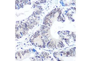 Immunohistochemistry of paraffin-embedded human colon carcinoma using SNRPB Rabbit pAb (ABIN6134519, ABIN6148214, ABIN6148215 and ABIN6219175) at dilution of 1:100 (40x lens). (SNRPB Antikörper  (AA 1-100))