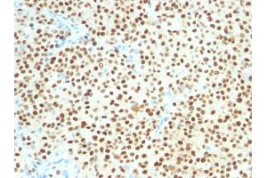 Formalin-fixed, paraffin-embedded human Melanoma stained with SOX10 Mouse Monoclonal Antibody (SOX10/1074).