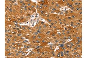 The image on the left is immunohistochemistry of paraffin-embedded Human liver cancer tissue using ABIN7131212(STARD8 Antibody) at dilution 1/20, on the right is treated with fusion protein. (STARD8 Antikörper)