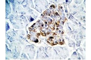 Human pancreas cancer tissue was stained by Rabbit Anti-GLP-1(7-36) -NH2 Antibody (GLP-1 Antikörper  (amidated))