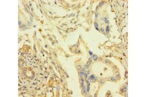 Immunohistochemistry of paraffin-embedded human pancreatic cancer using ABIN7167948 at dilution of 1:100 (ARHGAP27 Antikörper  (AA 1-300))