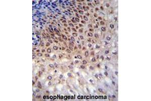 CCDC36 Antibody (C-term) immunohistochemistry analysis in formalin fixed and paraffin embedded human esophageal carcinoma followed by peroxidase conjugation of the secondary antibody and DAB staining. (CCDC36 Antikörper  (C-Term))