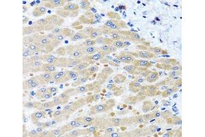 Immunohistochemistry of paraffin-embedded Human liver damage using DARS2 Polyclonal Antibody at dilution of 1:100 (40x lens). (DARS2 Antikörper)