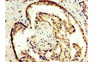 IHC image of ABIN7163426 diluted at 1:300 and staining in paraffin-embedded human prostate cancer performed on a Leica BondTM system.