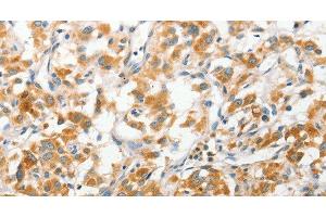 Immunohistochemistry of paraffin-embedded Human thyroid cancer tissue using ANAPC2 Polyclonal Antibody at dilution 1:30 (ANAPC2 Antikörper)
