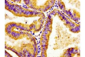 Immunohistochemistry of paraffin-embedded human endometrial cancer using ABIN7143338 at dilution of 1:100 (ADCY8 Antikörper  (AA 534-670))