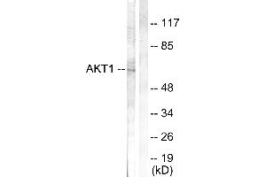 Immunohistochemistry analysis of paraffin-embedded human breast carcinoma tissue using Akt (Ab-308) antibody. (AKT1 Antikörper  (Thr308))
