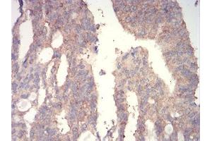 Immunohistochemical analysis of paraffin-embedded rectum cancer tissues using WNT3A mouse mAb with DAB staining. (WNT3A Antikörper  (AA 170-352))