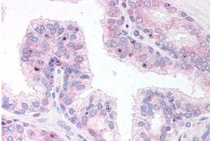 Human Prostate (formalin-fixed, paraffin-embedded) stained with ERG antibody ABIN295774 at 10 ug/ml followed by biotinylated anti-goat IgG secondary antibody ABIN481715, alkaline phosphatase-streptavidin and chromogen. (ERG Antikörper  (AA 469-481))