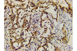 ABIN6277691 at 1/200 staining human lung cancer tissue sections by IHC-P.