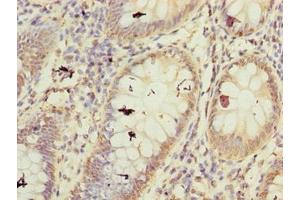 Immunohistochemistry of paraffin-embedded human colon cancer using ABIN7152486 at dilution of 1:100 (BTRC Antikörper  (AA 701-1000))