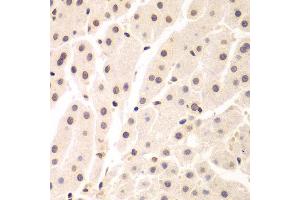 Immunohistochemistry of paraffin-embedded human liver cancer using UHRF2 antibody at dilution of 1:200 (400x lens).