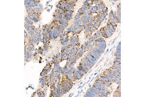 Immunohistochemistry of paraffin-embedded human colon carcinoma using  Rabbit mAb (ABIN7265424) at dilution of 1:1000 (40x lens). (ACSL4 Antikörper)