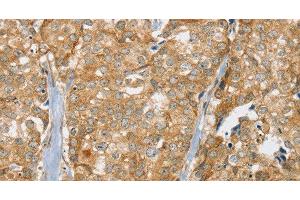 Immunohistochemistry of paraffin-embedded Human breast cancer tissue using SLC9A3R2 Polyclonal Antibody at dilution 1:30 (SLC9A3R2 Antikörper)