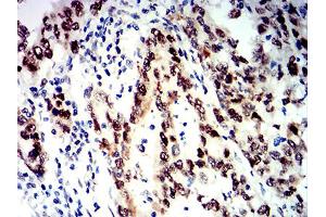 Immunohistochemical analysis of paraffin-embedded stomach cancer tissues using SMARCA1 mouse mAb with DAB staining. (SMARCA1 Antikörper  (AA 933-1070))