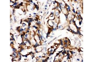 IHC-P: MEK1 antibody testing of human breast cancer tissue