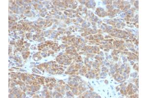 Formalin-fixed, paraffin-embedded human Melanoma stained with Bcl-2 Mouse Monoclonal Antibody (BCL2/782). (Bcl-2 Antikörper)
