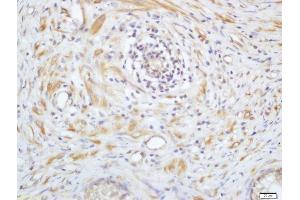 Formalin-fixed and paraffin embedded human prostate labeled with Anti-Phospho-PAK4(Ser99) Polyclonal Antibody, Unconjugated  at 1:200 followed by conjugation to the secondary antibody and DAB staining (PAK4/ 5 (pSer99) Antikörper)