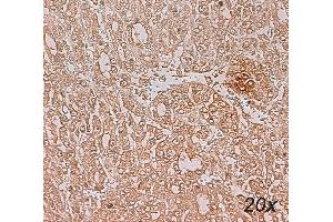 Human Liver - Hepatocarcinoma (HCC) Paraffin section, citrate, dilution 1:100