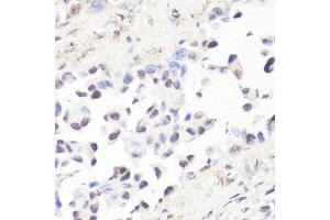 Immunohistochemistry of paraffin-embedded human lung cancer using P-MYC-T58 antibody (ABIN3019538, ABIN3019539, ABIN3019540 and ABIN6225454) at dilution of 1:100 (40x lens). (c-MYC Antikörper  (pThr58))