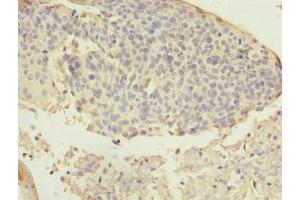 Immunohistochemistry of paraffin-embedded human cervical cancer using ABIN7144611 at dilution of 1:100 (ARMC7 Antikörper  (AA 1-198))