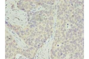 Immunohistochemistry of paraffin-embedded human gastric cancer using ABIN7142542 at dilution of 1:100 (RPS28 Antikörper  (AA 1-69))