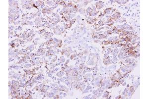 IHC-P Image NDRG1 antibody detects NDRG1 protein at membrane on human liver carcinoma by immunohistochemical analysis. (NDRG1 Antikörper)