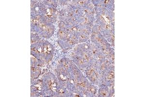 Immunohistochemical analysis of (ABIN387989 and ABIN2845007) on paraffin-embedded Human colon carcinoma tissue was performed on the Leica®BOND RXm. (IFITM3 Antikörper  (N-Term))