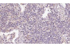ABIN6273155 at 1/100 staining Human lymph cancer tissue by IHC-P. (RND3 Antikörper  (Internal Region))