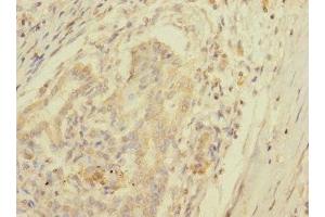 Immunohistochemistry of paraffin-embedded human pancreatic cancer using ABIN7157671 at dilution of 1:100 (SPC25 Antikörper  (AA 1-224))