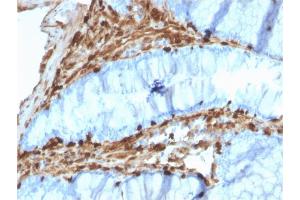 Formalin-fixed, paraffin-embedded human Colon Carcinoma stained with Annexin A1 Mouse Monoclonal Antibody (CPTC-ANXA1-1). (Annexin a1 Antikörper)