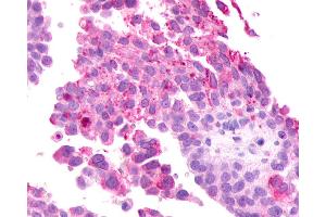 Anti-GRM2 / MGLUR2 antibody IHC of human Ovary, Carcinoma. (GRM2 Antikörper  (N-Term))