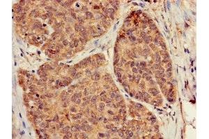 Immunohistochemistry of paraffin-embedded human ovarian cancer using ABIN7154745 at dilution of 1:100 (GNB5 Antikörper  (AA 1-353))