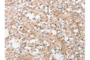 The image on the left is immunohistochemistry of paraffin-embedded Human thyroid cancer tissue using ABIN7131059(SIGLEC9 Antibody) at dilution 1/30, on the right is treated with fusion protein. (SIGLEC9 Antikörper)