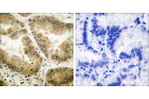 Peptide - +Immunohistochemical analysis of paraffin-embedded human lung carcinoma tissue using HDAC7 antibody (#C0227). (HDAC7 Antikörper)