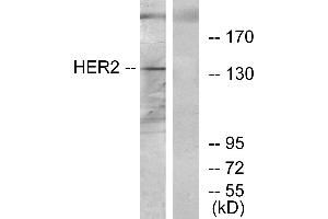 Immunohistochemistry analysis of paraffin-embedded human breast carcinoma tissue using HER2 antibody. (ErbB2/Her2 Antikörper)